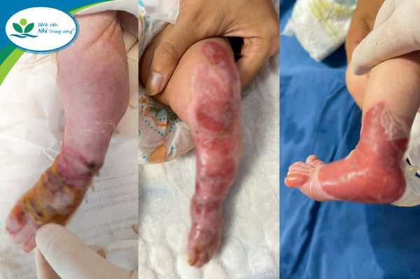 Bé gái sơ sinh mắc bệnh di truyền hiếm gặp gây trợt loét, mất da bàn chân 2 bên -0