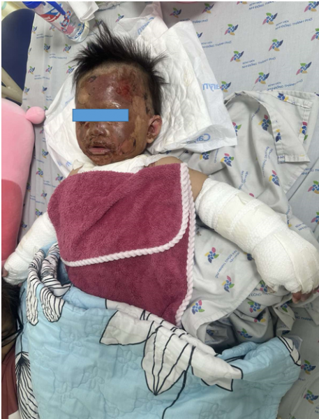 Bếp gas mini bất ngờ phát nổ khiến bé gái 2 tuổi bị bỏng nặng -0
