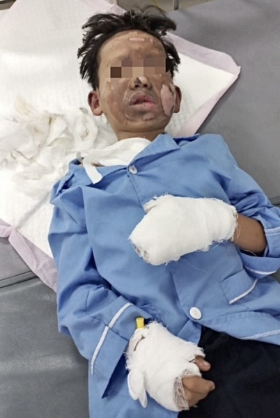 Bé trai 8 tuổi bị bỏng nặng do máy tính phát nổ -0