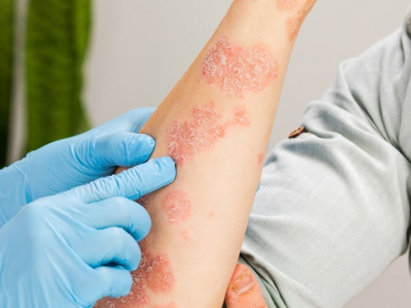7 bệnh về da phổ biến thường gặp trong mùa hè -0