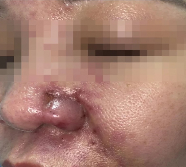 Người phụ nữ bị tắc mạch vùng mũi do tiêm filler tại cơ sở người quen -0