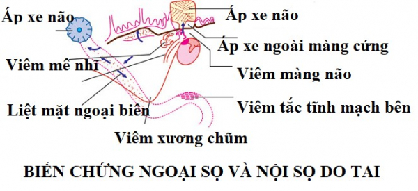 Phát hiện sớm các biến chứng từ bệnh lí viêm tai giữa -0