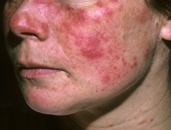 Những biến chứng thường gặp của bệnh lupus ban đỏ -0