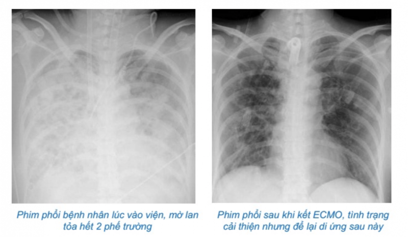 Tự điều trị cúm, bệnh nhân phải chạy ECMO 37 ngày do viêm phổi bội nhiễm -0