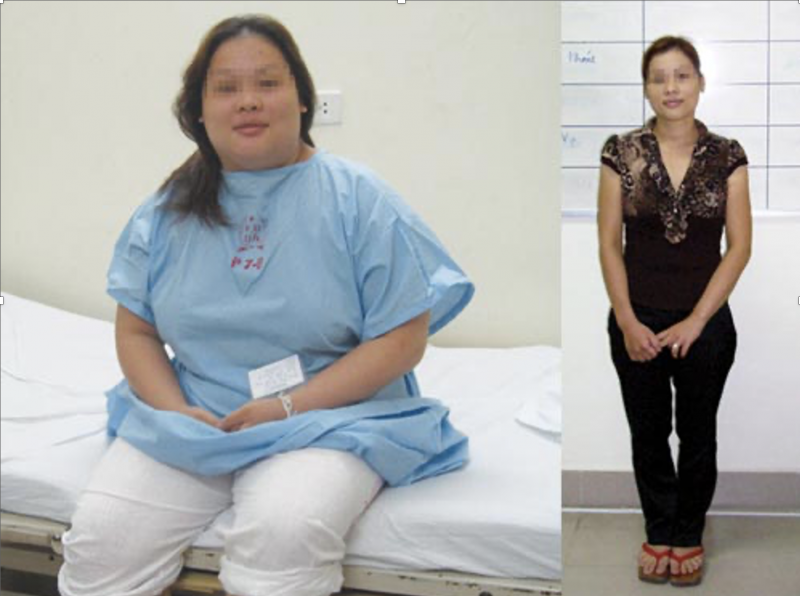 Các phương pháp điều trị thừa cân, béo phì -0