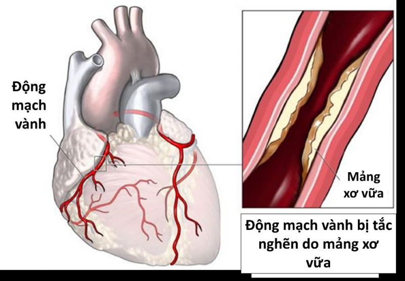  Bệnh nhồi máu cơ tim đang có xu hướng trẻ hoá -0