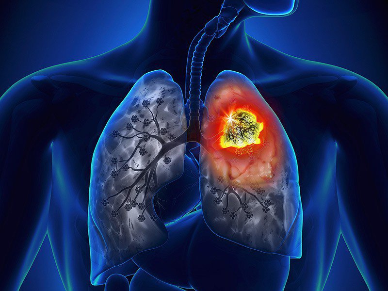 Hút thuốc lá chiếm 80% nguyên nhân gây ung thư phổi -0