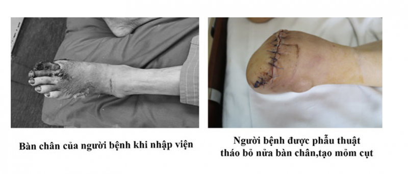 Bệnh nhân phải phẫu thuật tháo bỏ nửa bàn chân vì bệnh đái tháo đường -0