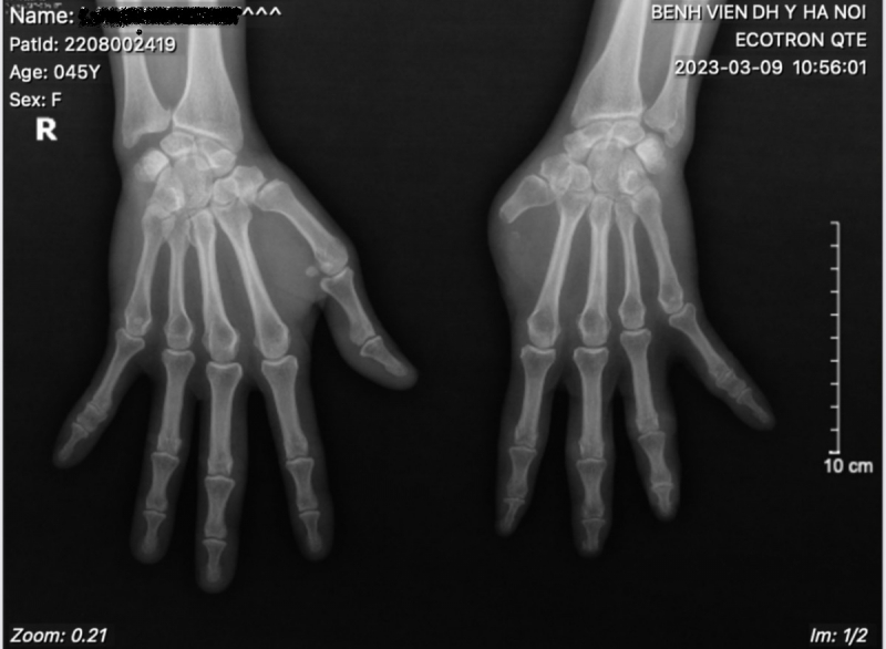 Bệnh viện Đại học Y phẫu thuật tạo hình thành công ghép ngón tay cái từ ngón chân -0