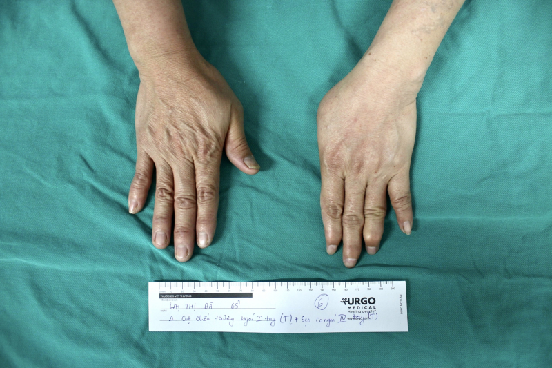 Bệnh viện Đại học Y phẫu thuật tạo hình thành công ghép ngón tay cái từ ngón chân -0