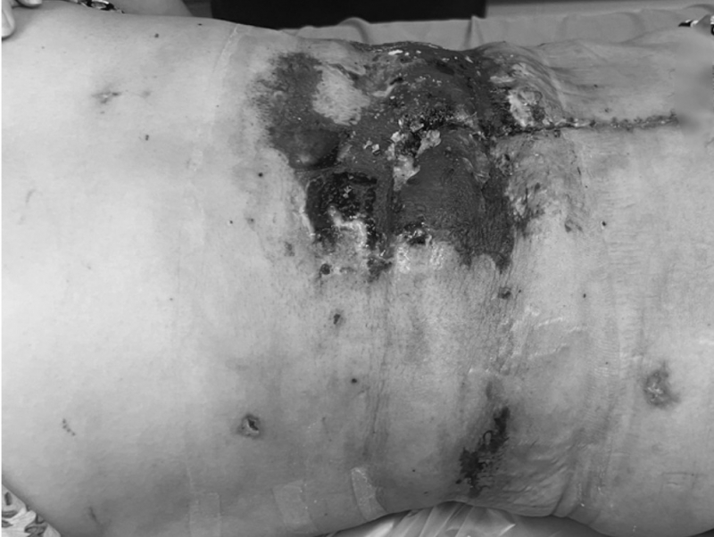 Người phụ nữ hoại tử da vùng rốn và thắt lưng sau khi hút mỡ bụng, cắt sẹo tại spa  -0