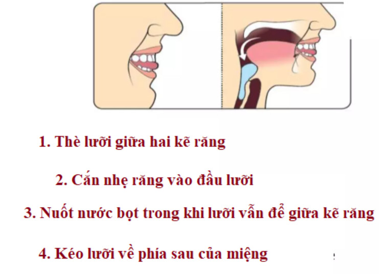 Bài tập phục hồi chức năng cơ quan tổn thương do bệnh bạch hầu thanh quản -0